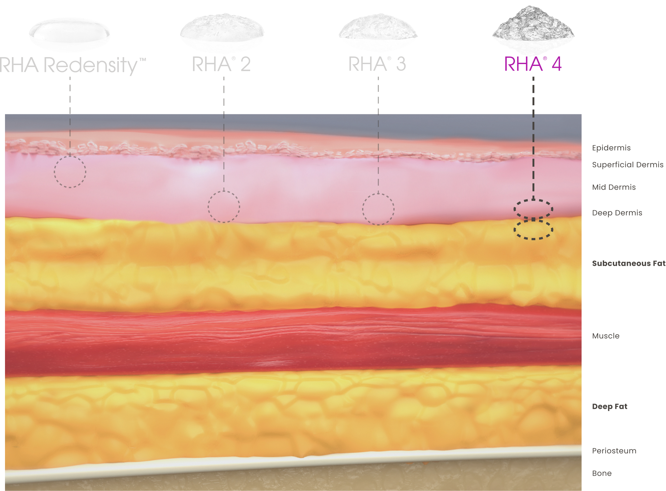 RHA Redensity injection at the superficial dermis compared to the other gels