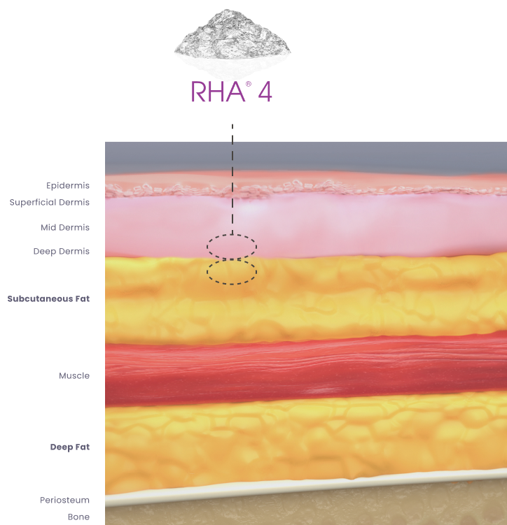 RHA Redensity Gel