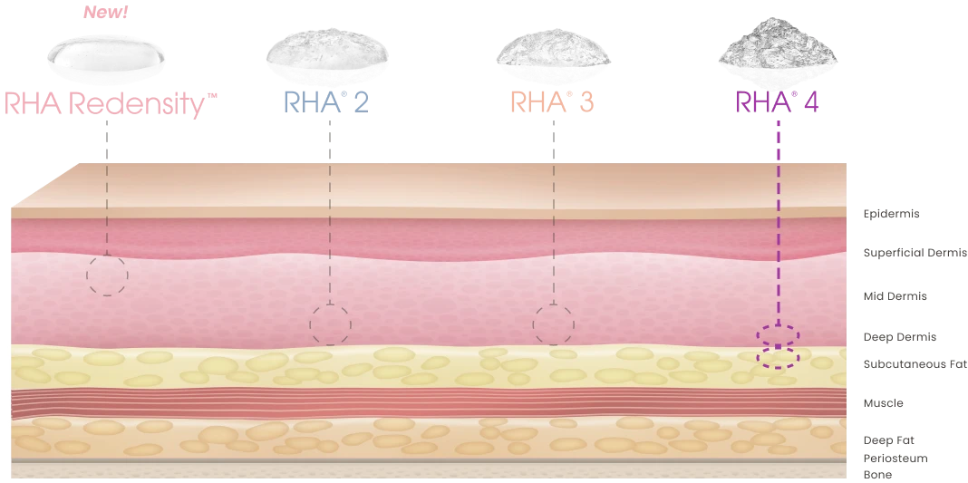 RHA 4 injection at the deep dermis to superficial subcutaneous tissue for correction compared to the other gels.