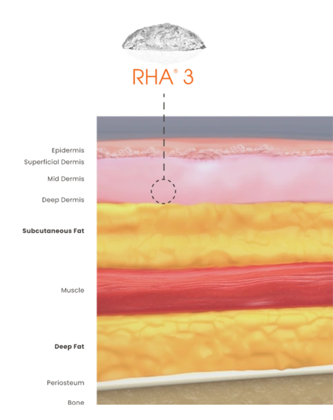 RHA 3 injection at the mid-to-deep dermis for correction compared to the other gels.